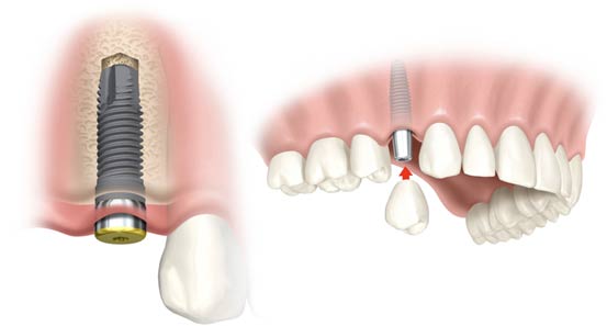 Implantáció